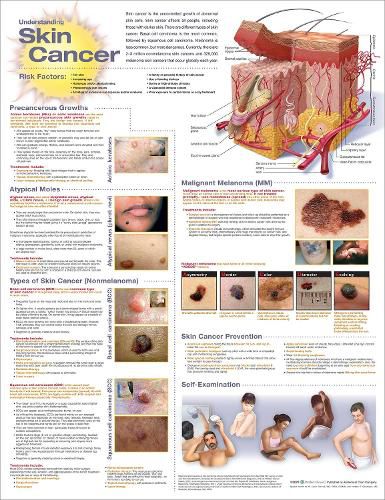 Cover image for Understanding Skin Cancer Anatomical Chart