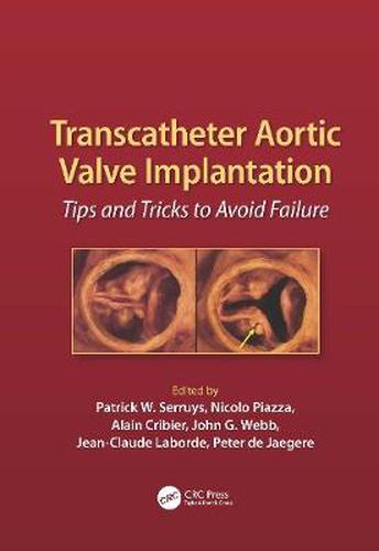 Cover image for Transcatheter Aortic Valve Implantation: Tips and Tricks to Avoid Failure