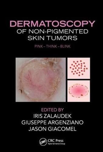 Cover image for Dermatoscopy of Non-Pigmented Skin Tumors: Pink - Think - Blink