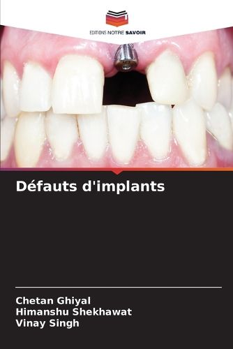 Cover image for Defauts d'implants