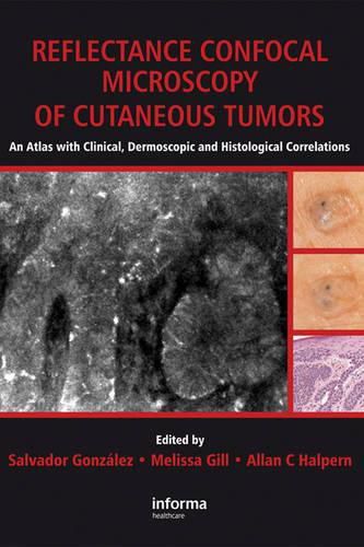 Cover image for Reflectance Confocal Microscopy of Cutaneous Tumors: An Atlas with Clinical, Dermoscopic and Histological Correlations