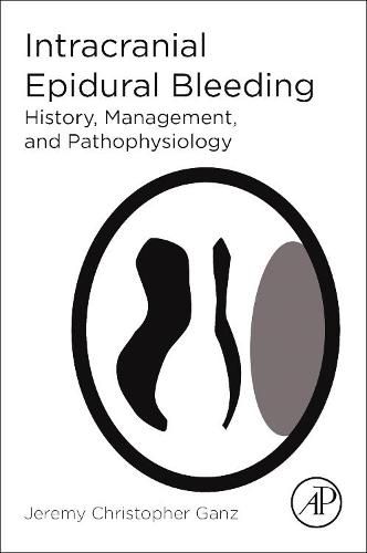 Cover image for Intracranial Epidural Bleeding: History, Management, and Pathophysiology