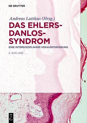 Das Ehlers-Danlos-Syndrom: Eine Interdisziplinare Herausforderung