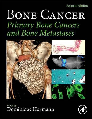 Cover image for Bone Cancer: Primary Bone Cancers and Bone Metastases