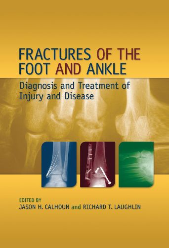 Cover image for Fractures of the Foot and Ankle: Diagnosis and Treatment of Injury and Disease