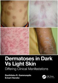 Cover image for Dermatoses in Dark Vs Light Skin