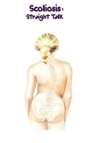 Cover image for Scoliosis: Straight Talk