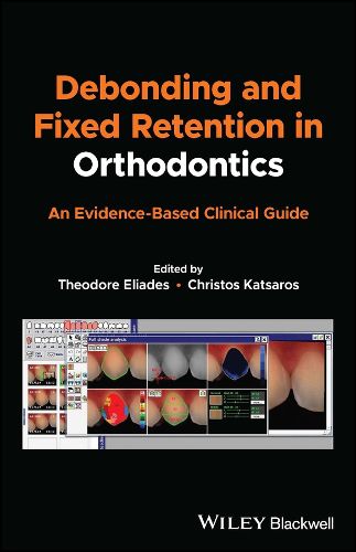 Cover image for Debonding and Fixed Retention in Orthodontics