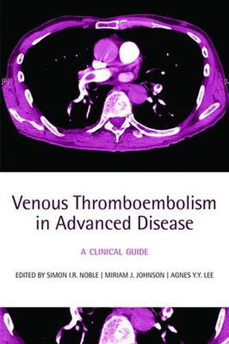 Cover image for Venous Thromboembolism in Advanced Disease: A clinical guide