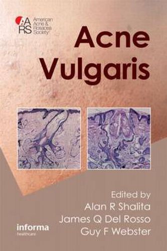 Cover image for Acne Vulgaris