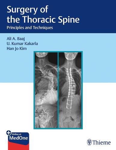 Cover image for Surgery of the Thoracic Spine: Principles and Techniques