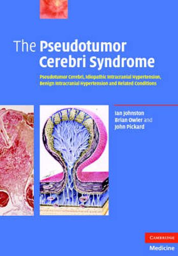 The Pseudotumor Cerebri Syndrome: Pseudotumor Cerebri, Idiopathic Intracranial Hypertension, Benign Intracranial Hypertension and Related Conditions