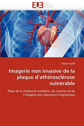 Cover image for Imagerie Non Invasive de La Plaque D'Athrosclrose Vulnrable