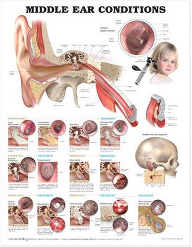 Cover image for Middle Ear Conditions Anatomical Chart