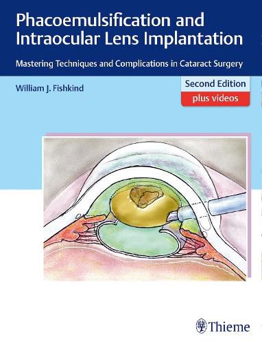 Cover image for Phacoemulsification and Intraocular Lens Implantation: Mastering Techniques and Complications in Cataract Surgery