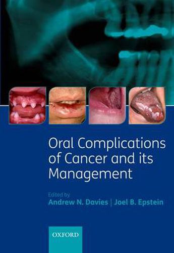 Cover image for Oral Complications of Cancer and its Management