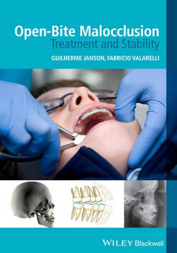 Cover image for Open-Bite Malocclusion - Treatment and Stability