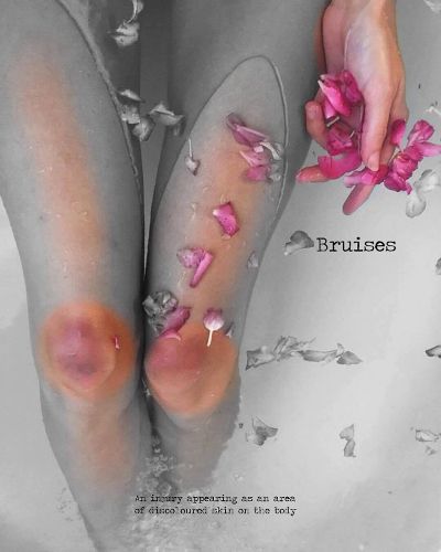 Cover image for Bruises