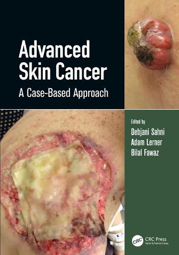 Cover image for Advanced Skin Cancer: A Case-Based Approach