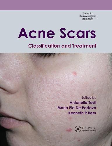 Cover image for Acne Scars: Classification and Treatment