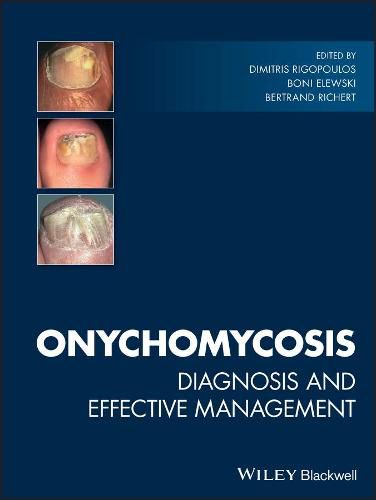 Cover image for Onychomycosis: Diagnosis and Effective Management