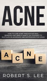 Cover image for Acne: How to Cure Acne through Natural Remedies and Simple Habits. Say Goodbye to Pustules, Blackheads and Whiteheads for Good!