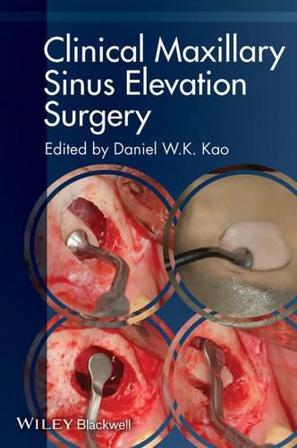 Cover image for Clinical Maxillary Sinus Elevation Surgery