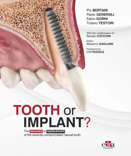 Cover image for Tooth or Implant
