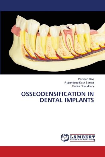 Cover image for Osseodensification in Dental Implants