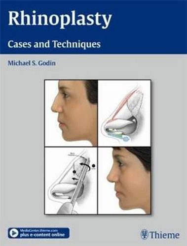 Cover image for Rhinoplasty - Cases and Techniques: Cases and Techniques