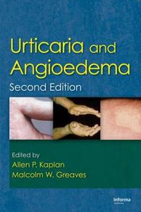 Cover image for Urticaria and Angioedema
