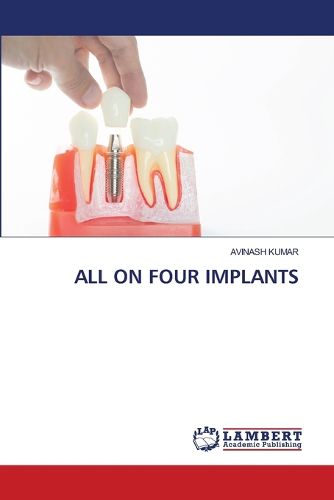 Cover image for All on Four Implants