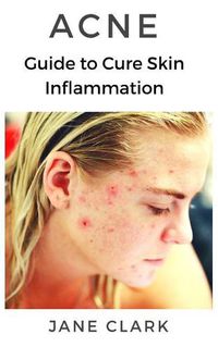 Cover image for Acne: Guide to Cure Skin Inflammation