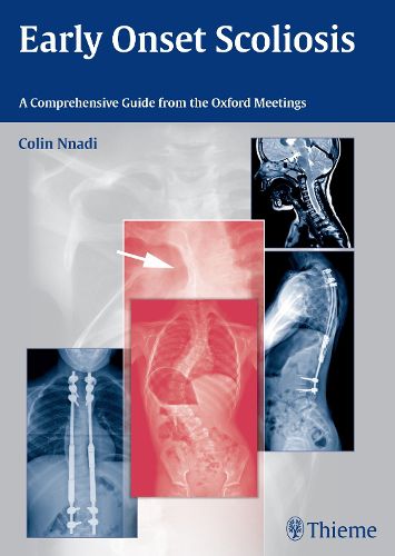 Cover image for Early Onset Scoliosis: A Comprehensive Guide from the Oxford Meetings