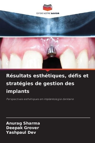 Cover image for Resultats esthetiques, defis et strategies de gestion des implants