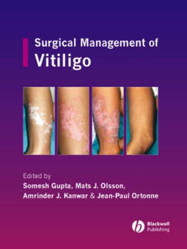 Cover image for Surgical Management of Vitiligo