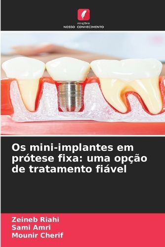 Cover image for Os mini-implantes em protese fixa