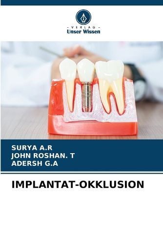 Cover image for Implantat-Okklusion
