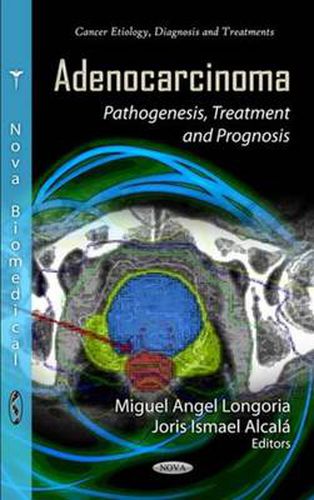 Cover image for Adenocarcinoma: Pathogenesis, Treatment & Prognosis