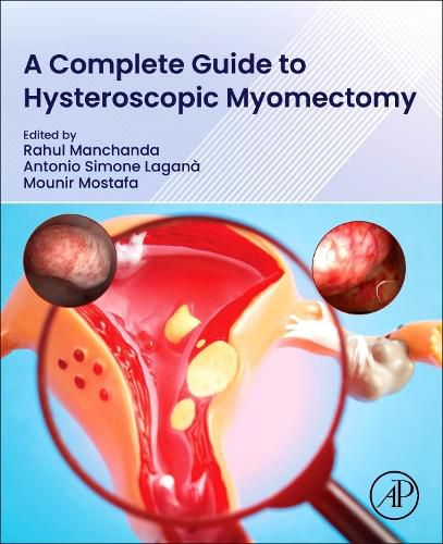 Cover image for A Complete Guide to Hysteroscopic Myomectomy