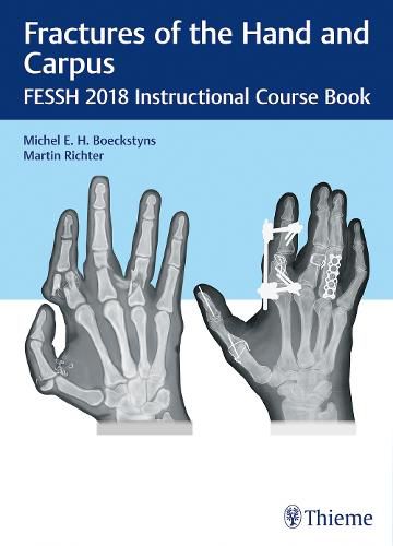 Fractures of the Hand and Carpus: FESSH 2018 Instructional Course Book