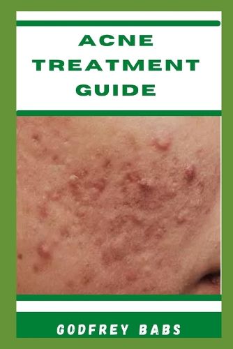 Acne Treatment Guide