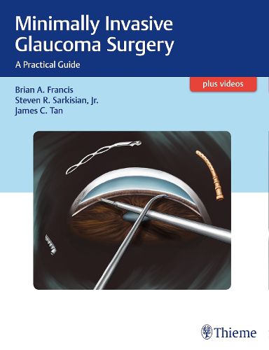 Cover image for Minimally Invasive Glaucoma Surgery: A Practical Guide