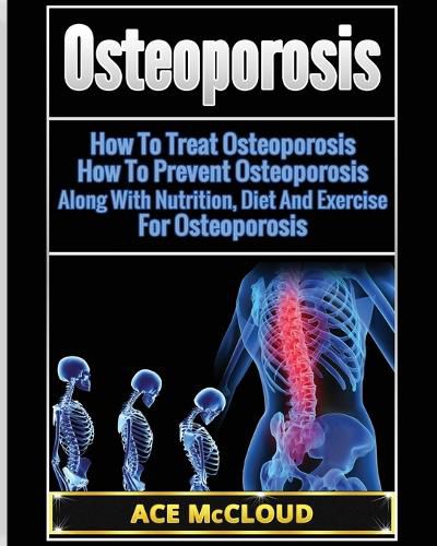 Cover image for Osteoporosis: How To Treat Osteoporosis: How To Prevent Osteoporosis: Along With Nutrition, Diet And Exercise For Osteoporosis