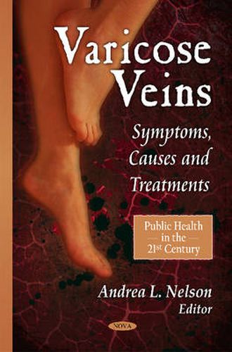 Varicose Veins: Symptoms, Causes & Treatments