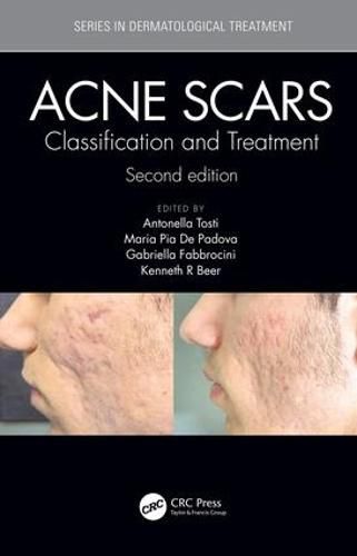 Cover image for Acne Scars: Classification and Treatment