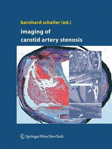 Cover image for Imaging of Carotid Artery Stenosis