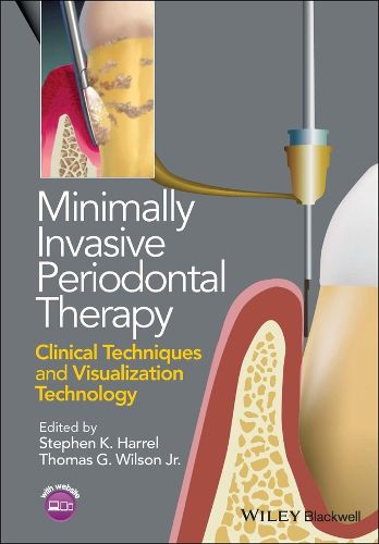 Cover image for Minimally Invasive Periodontal Therapy: Clinical Techniques and Visualization Technology