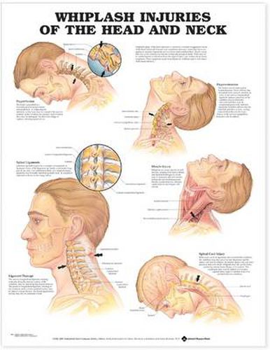 Cover image for Whiplash Injuries of the Head and Neck Anatomical Chart