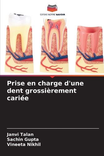 Cover image for Prise en charge d'une dent grossierement cariee